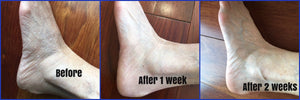 Before and After Photo and Testimonial | Liquid Skin Salve for Feet