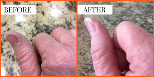 Before and After Photo and Testimonial | Liquid Skin Salve for Dry Skin